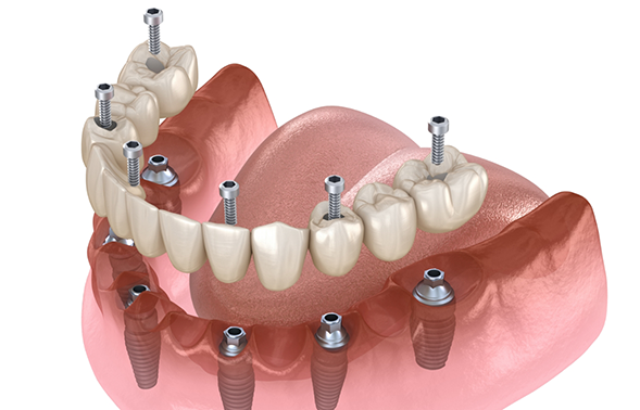 Illustration of a full denture being secured onto six dental implants throughout the arch