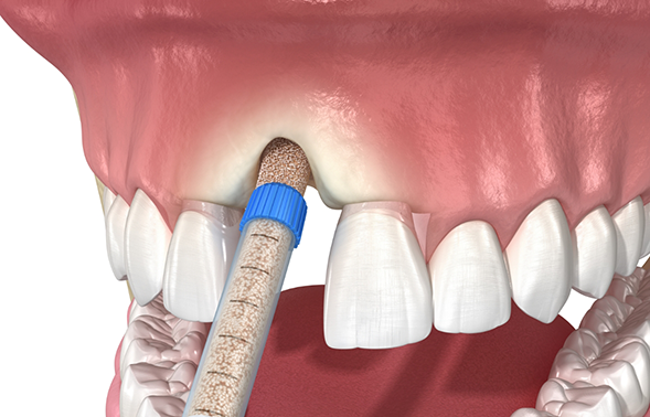 Illustration of bone grafting material being applied to the jawbone where a tooth is lost