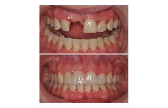 Close up of a mouth before and after replacing a missing front tooth
