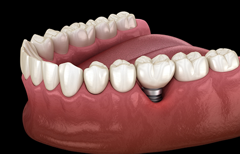 Illustration of a dental implant with a crown replacing one missing tooth