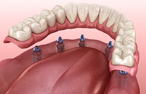 Illustration of a full denture being secured onto six dental implants