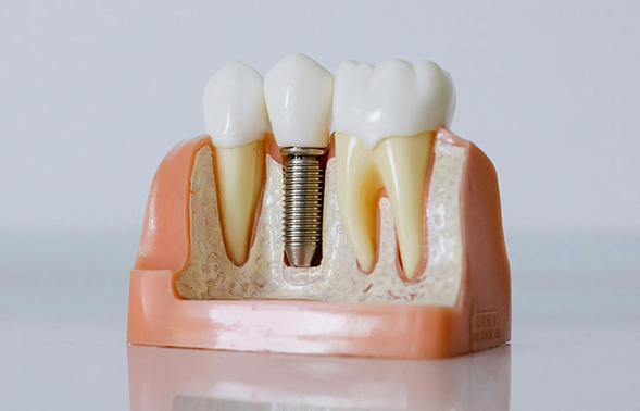 Model of a dental implant between two natural teeth