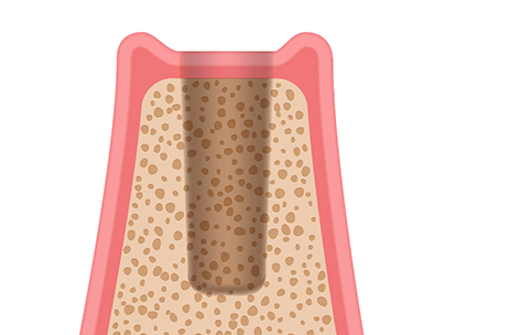 Illustration of a section of the jawbone where a tooth is missing