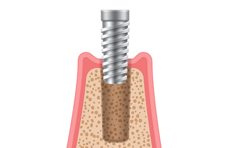 Illustration of a dental implant post being placed into the jawbone