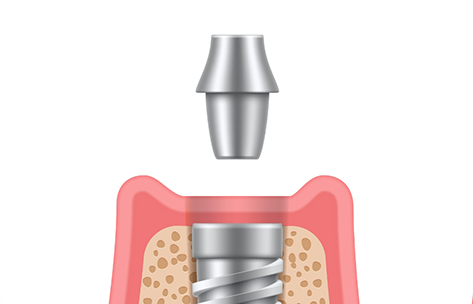 Illustration of an abutment being placed atop a dental implant in the jaw