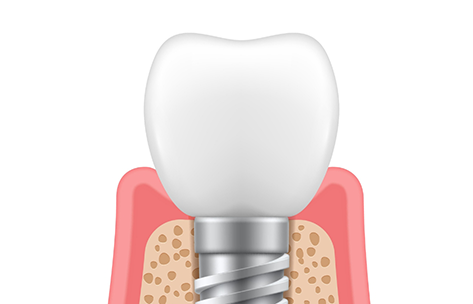 Illustration of a dental crown placed atop a dental implant