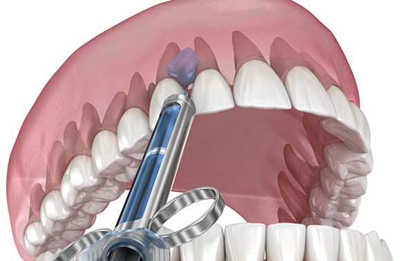Illustration of an injection in the upper gums