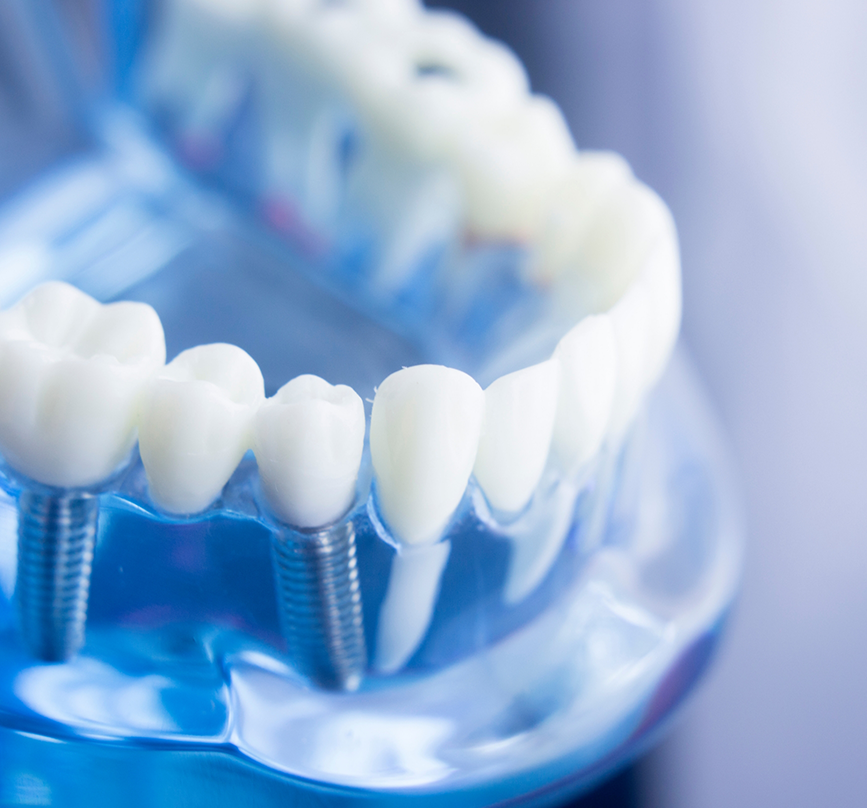 Model of the mouth with two dental implants