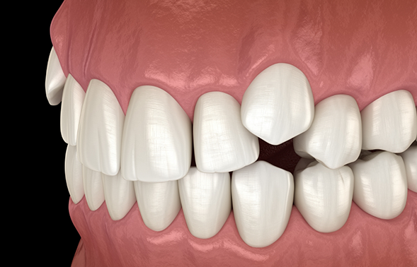 Illustration of a mouth with impacted canine teeth