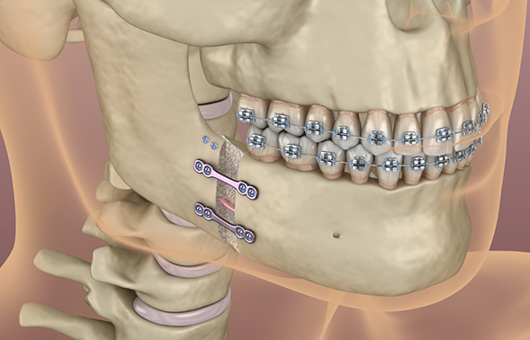 Illustrated x-ray of a person with braces on their teeth and orthodontic bite correction devices in their jawbone