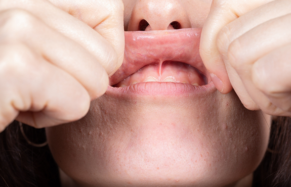Close up of a person pulling back their upper lip