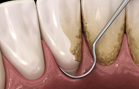 Illustration of scaling and root planing