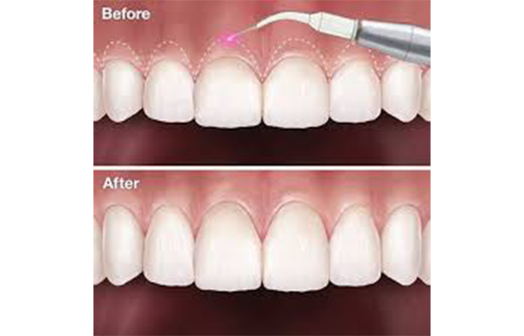 Illustration of a mouth before and after correcting a gummy smile