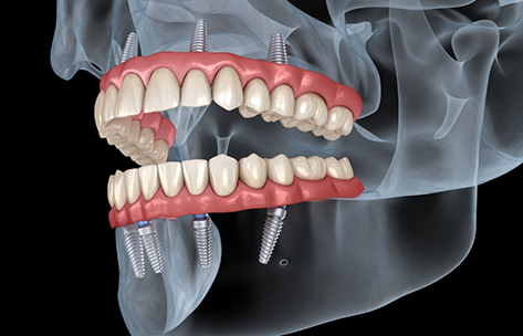 Illustrated x-ray of a person with implant dentures replacing all of their teeth