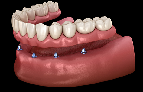 Illustration of a removable implant denture