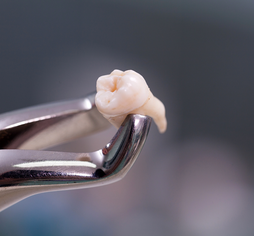 Dental forceps holding an extracted tooth