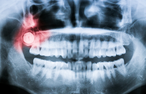Dental x-ray showing an impacted wisdom tooth