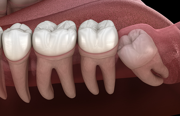 Illustration of an impacted wisdom tooth pressing against the adjacent tooth