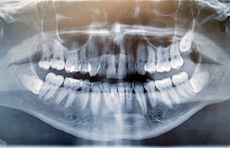 X-ray of a mouth with an impacted wisdom tooth