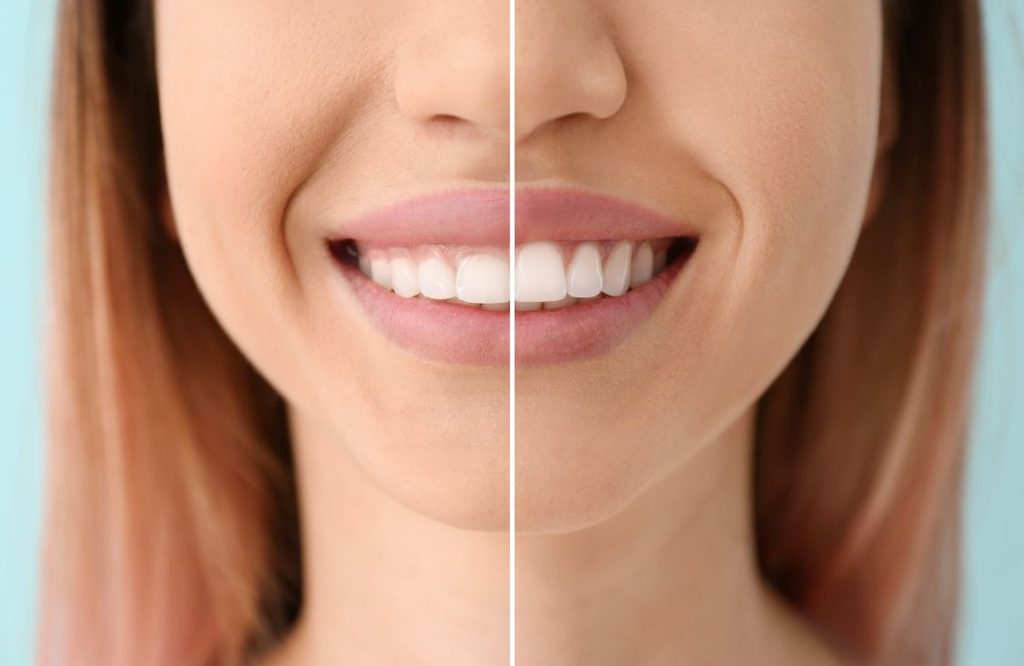 A woman before and after wisdom tooth surgery